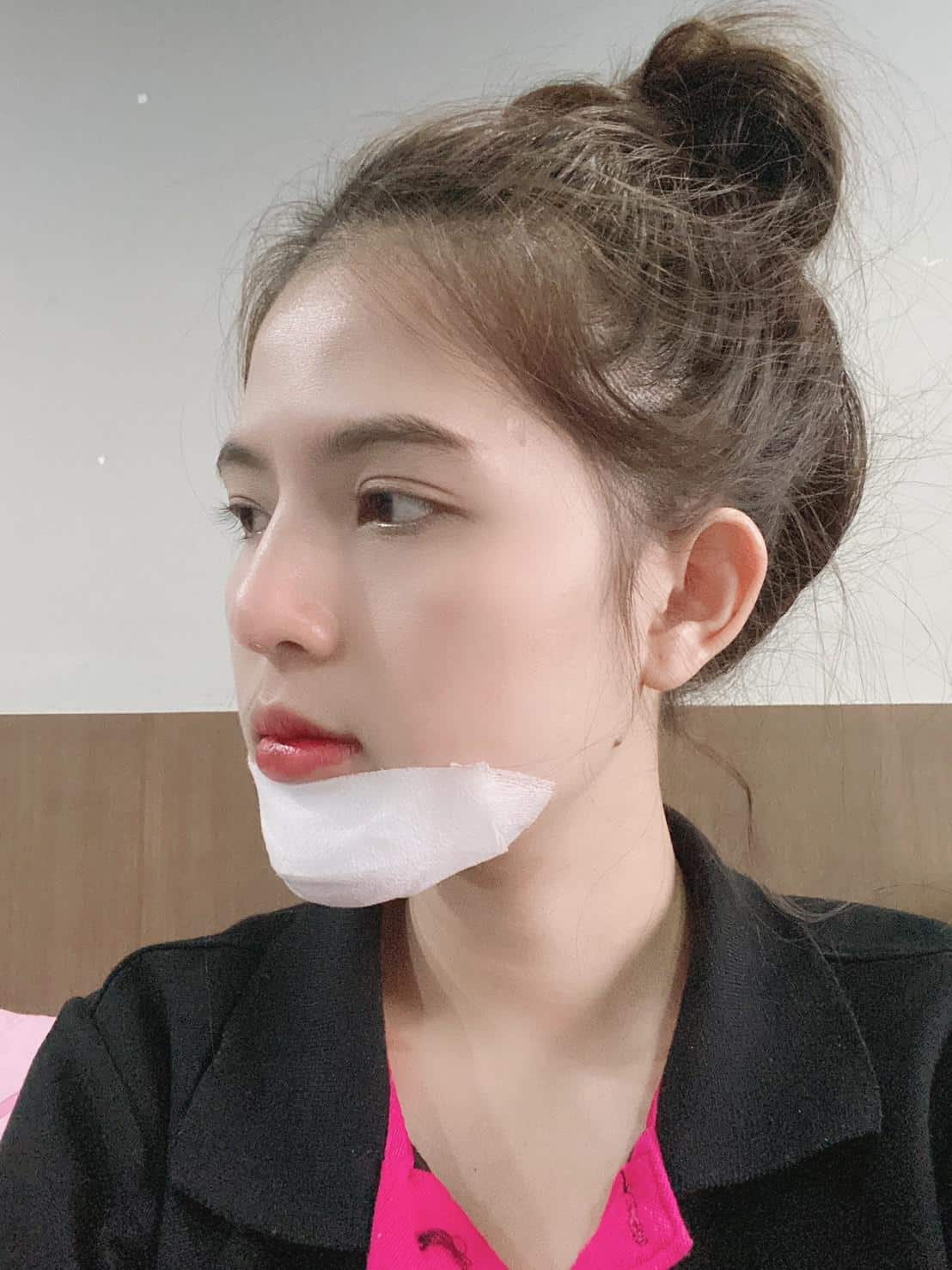 Chin Augmentation Review day4