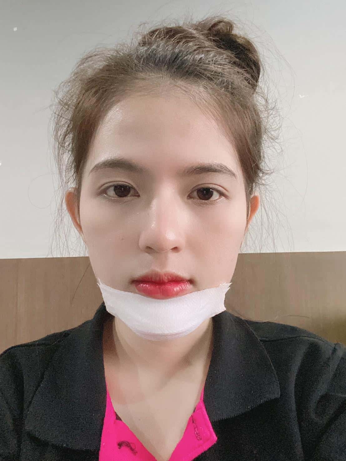 Chin Augmentation Review day4