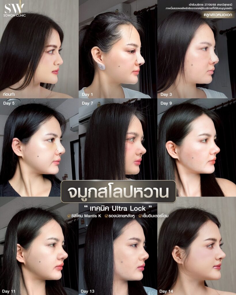 ถอดเฝือก 01