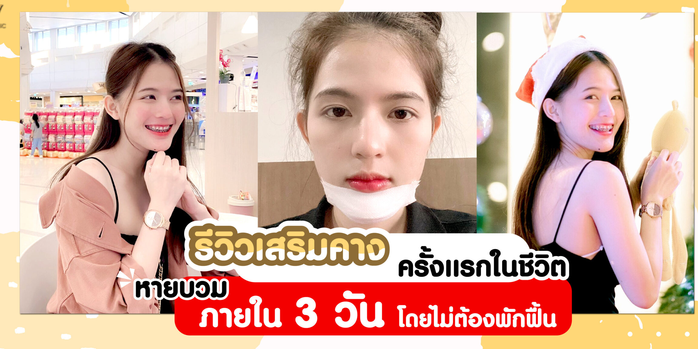 รีวิวเสริมคาง ครั้งเเรกในชีวิต หายบวมภายใน 3 วันโดยไม่ต้องพักฟื้น