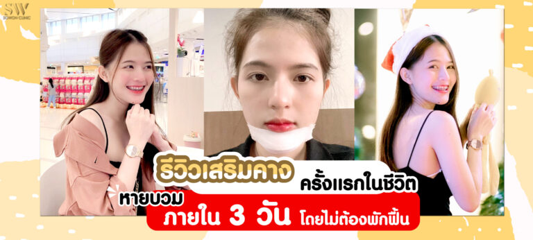รีวิวเสริมคาง ครั้งเเรกในชีวิต หายบวมภายใน 3 วันโดยไม่ต้องพักฟื้น