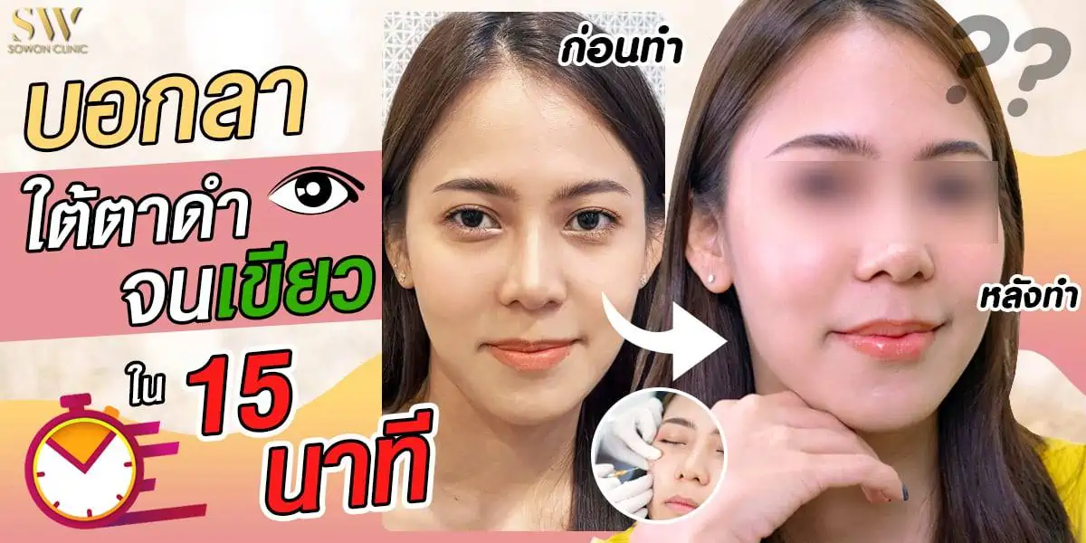 ฟิลเลอร์ใต้ตา ฟิลเลอร์ใต้ตา