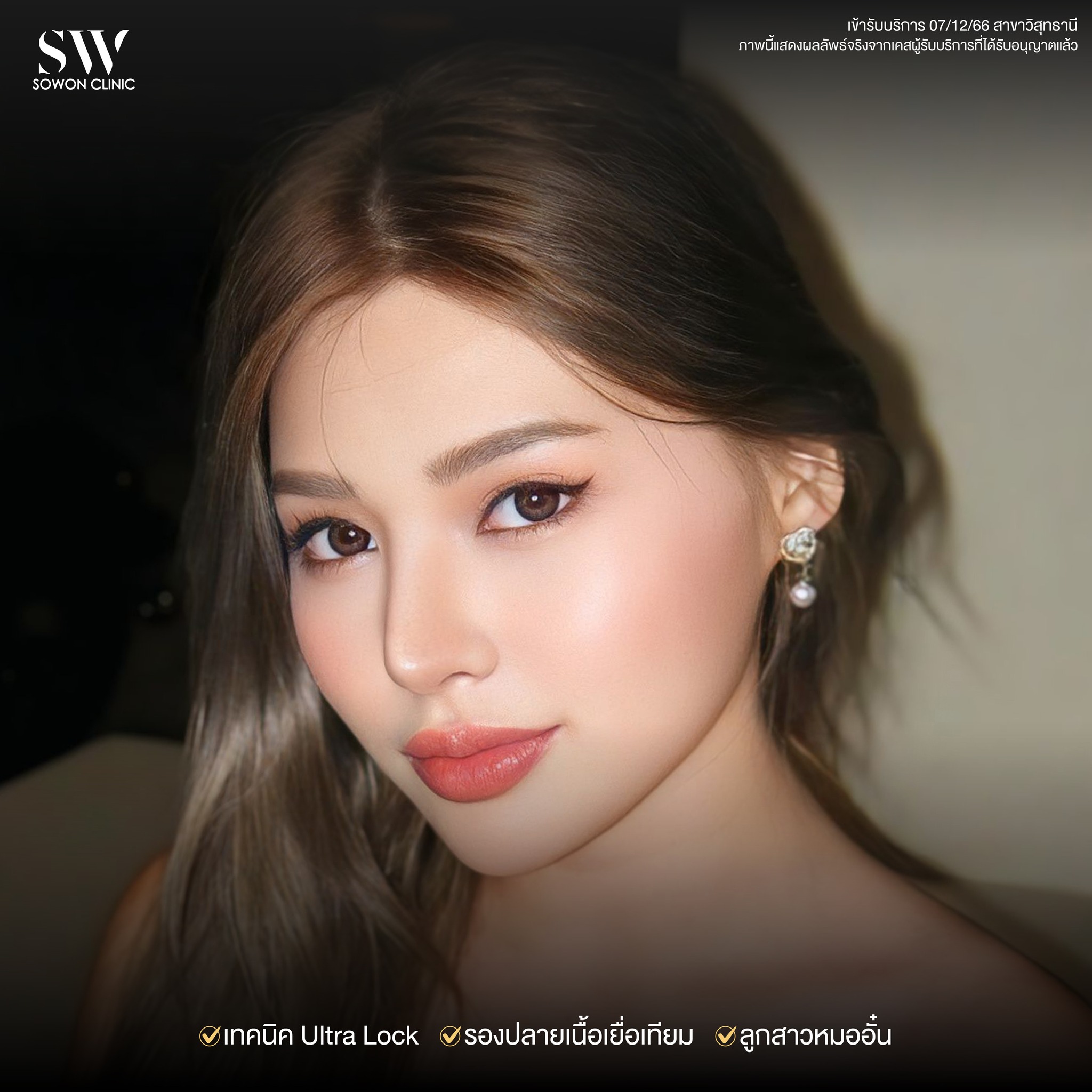 เสริมจมูกรีวิว 013