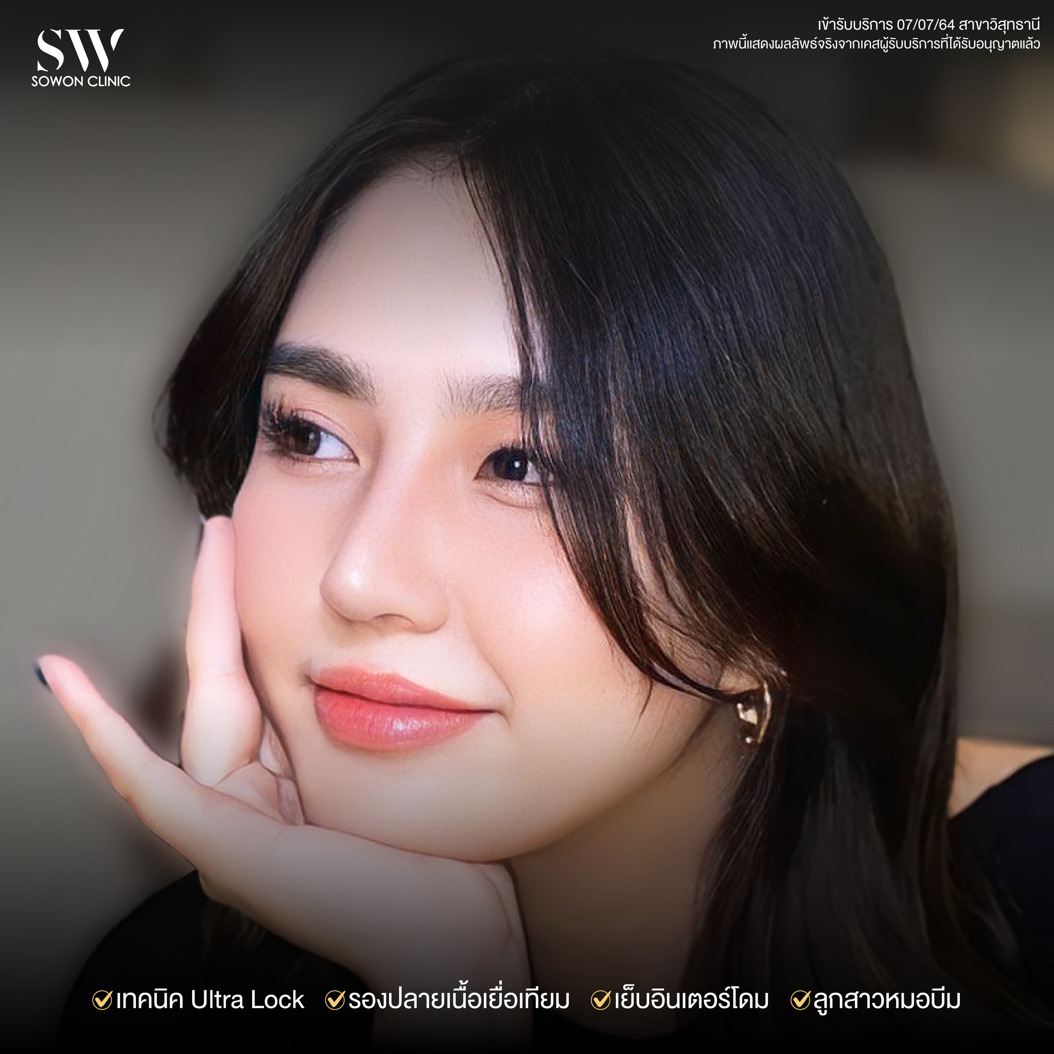 เสริมจมูกรีวิว 03