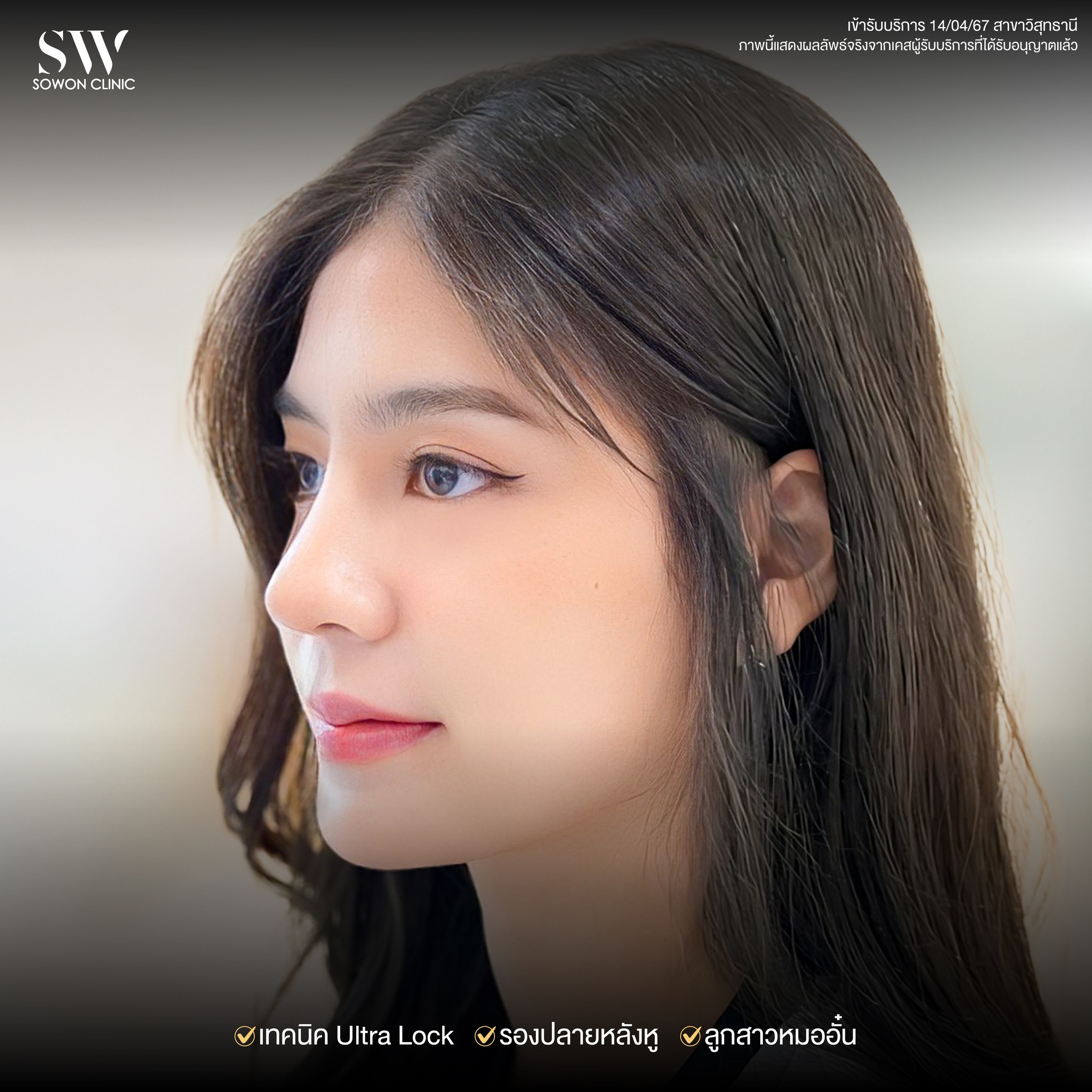 เสริมจมูกรีวิว 06