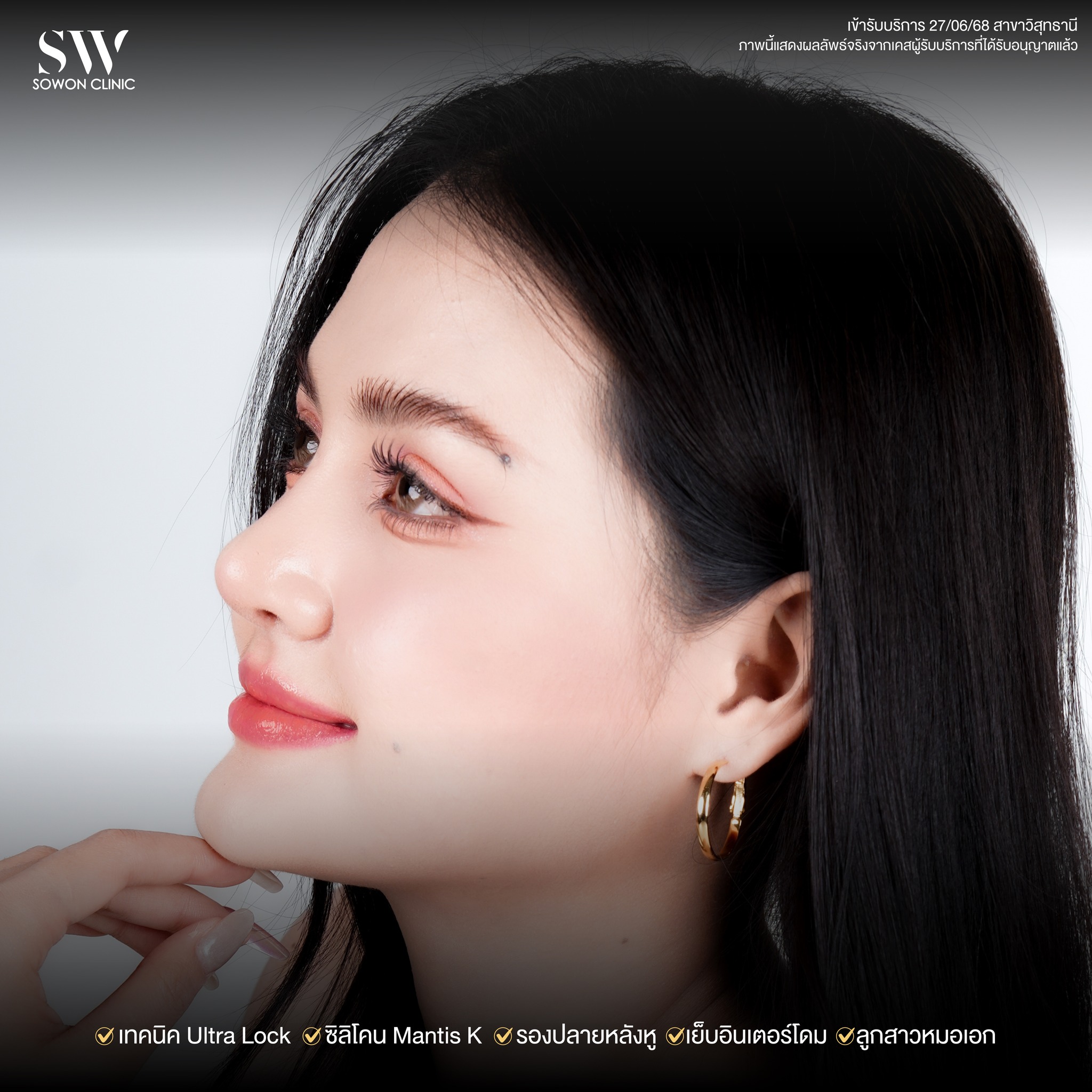 เสริมจมูกรีวิว 08