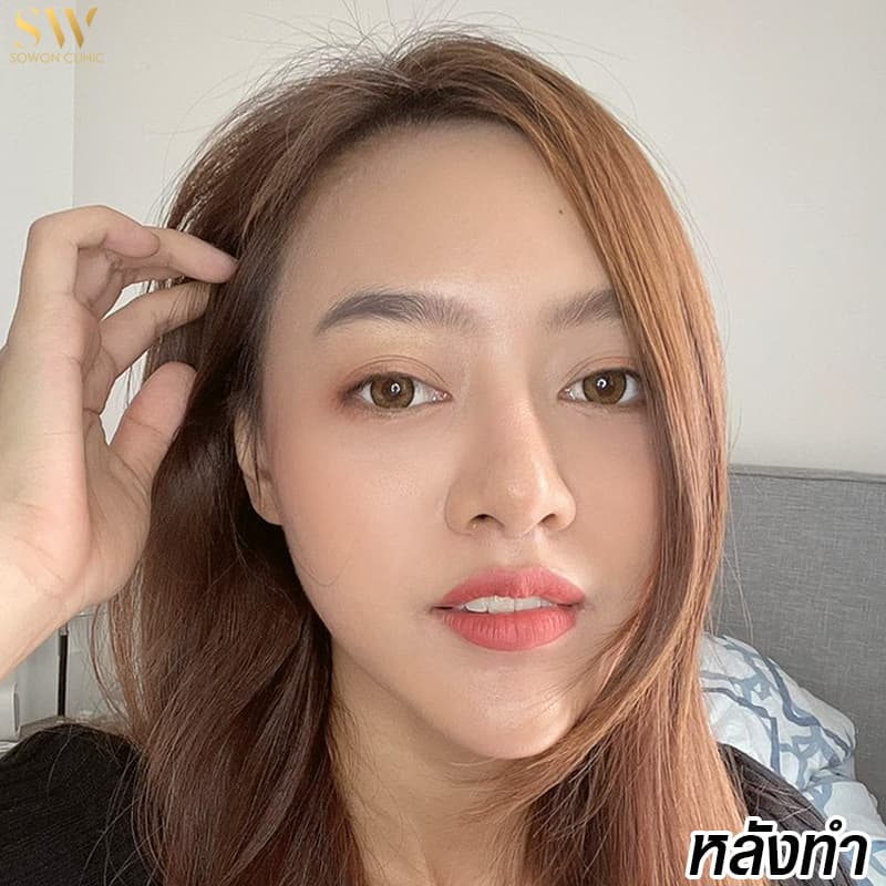 รีวิวฟิลเลอร์ใต้ตา
