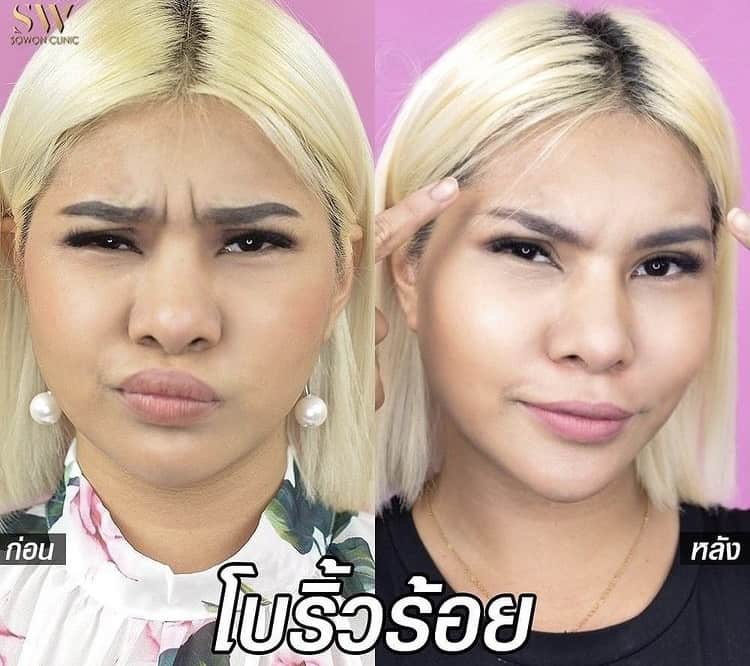 โบท็อกริ้วรอย