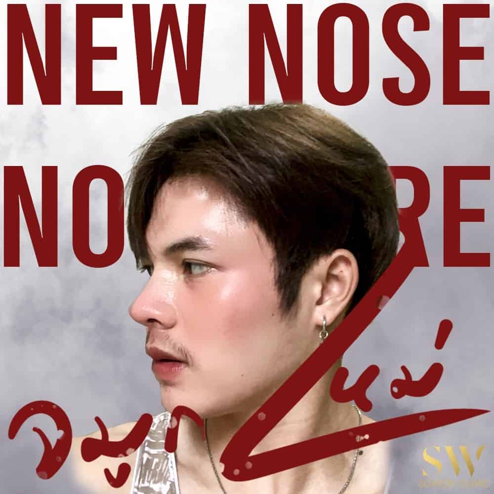 เสริมจมูกผู้ชาย