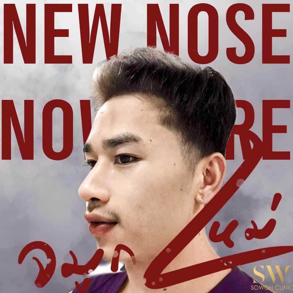 เสริมจมูกผู้ชาย