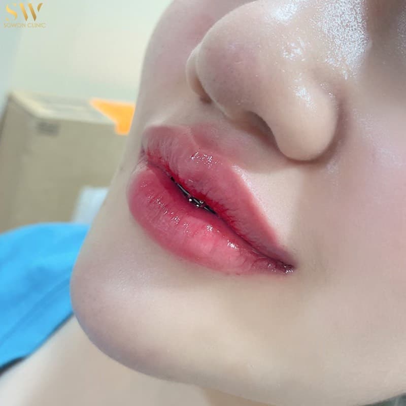 รีวิวฟิลเลอร์ปาก