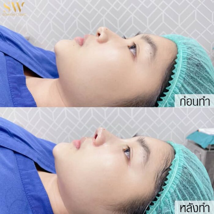 เสริมจมูก (4) เสริมจมูก (4)