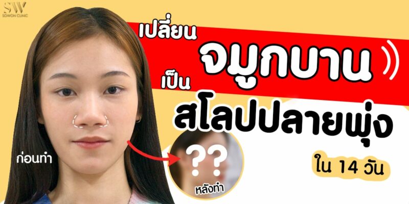 เสริมจมูก จมูกบาน