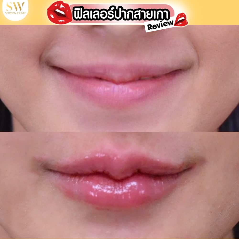 รีวิวฟิลเลอร์ปาก
