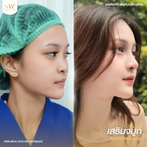 รีวิวจมูกลูกสาว SowonClinic07