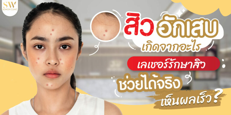 สิวอักเสบ