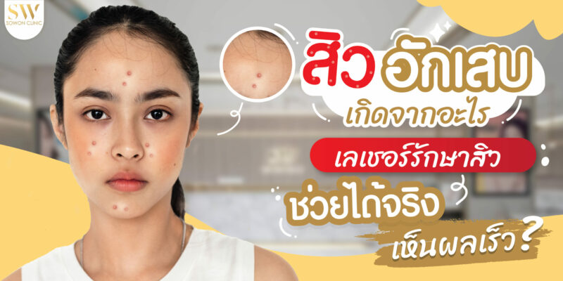 สิวอักเสบ