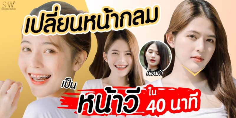 เสริมคาง คางสั้น