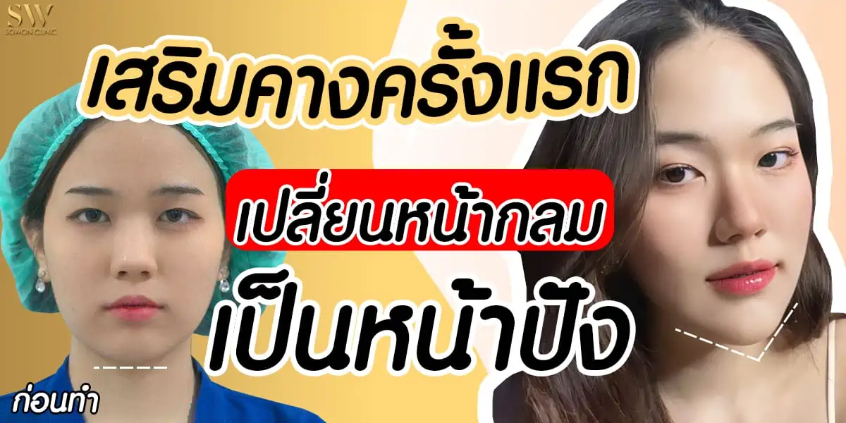 คางสั้น เสริมคาง