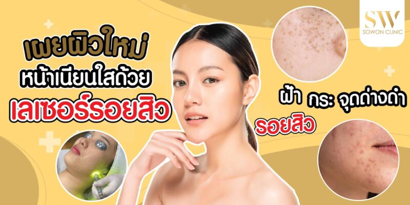 เลเซอร์รอยสิว