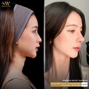 รีวิวเสริมจมูกที-Sowonclinic