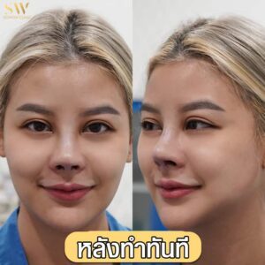 แก้จมูก Sowon clinic