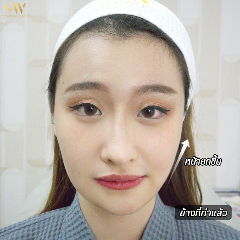 adbotoxfacelift03