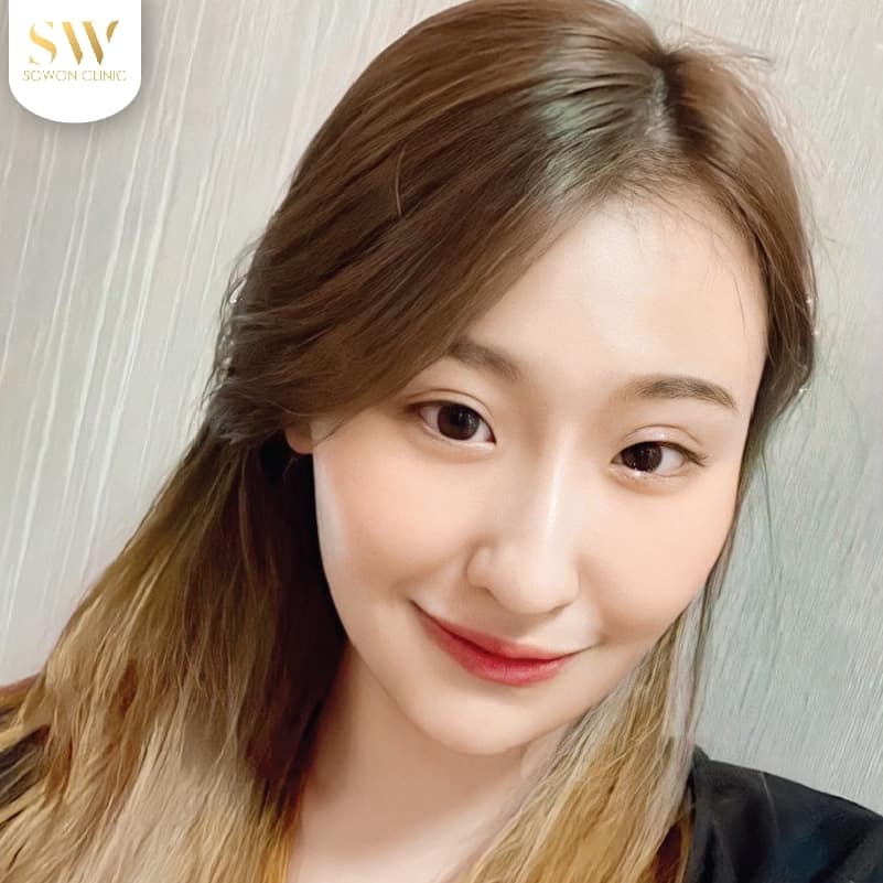 adbotoxfacelift03 ฉีดโบท็อก