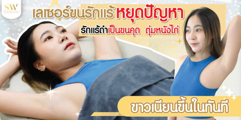 เลเซอร์ขนรักแร้