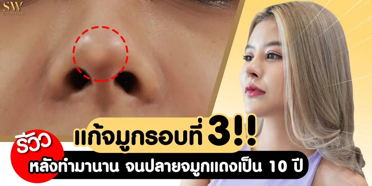 รีวิวแก้จมูกรอบ 3 หลังทำมานาน จนปลายจมูกบางแดง เป็น 10 ปี!! -