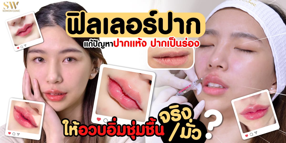 ฟิลเลอร์ปากอวบอิ่ม ฟิลเลอร์ปากอวบอิ่ม