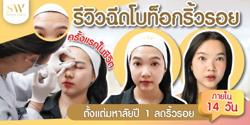 รีวิวฉีดโบท็อกริ้วรอย ครั้งแรกในชีวิต-01 รีวิวฉีดโบท็อกริ้วรอย ครั้งแรกในชีวิต-01