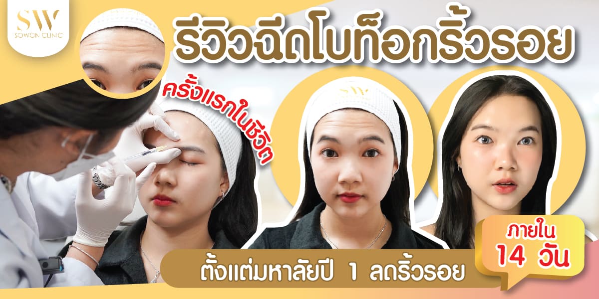 รีวิวฉีดโบท็อกริ้วรอย ครั้งแรกในชีวิต-01