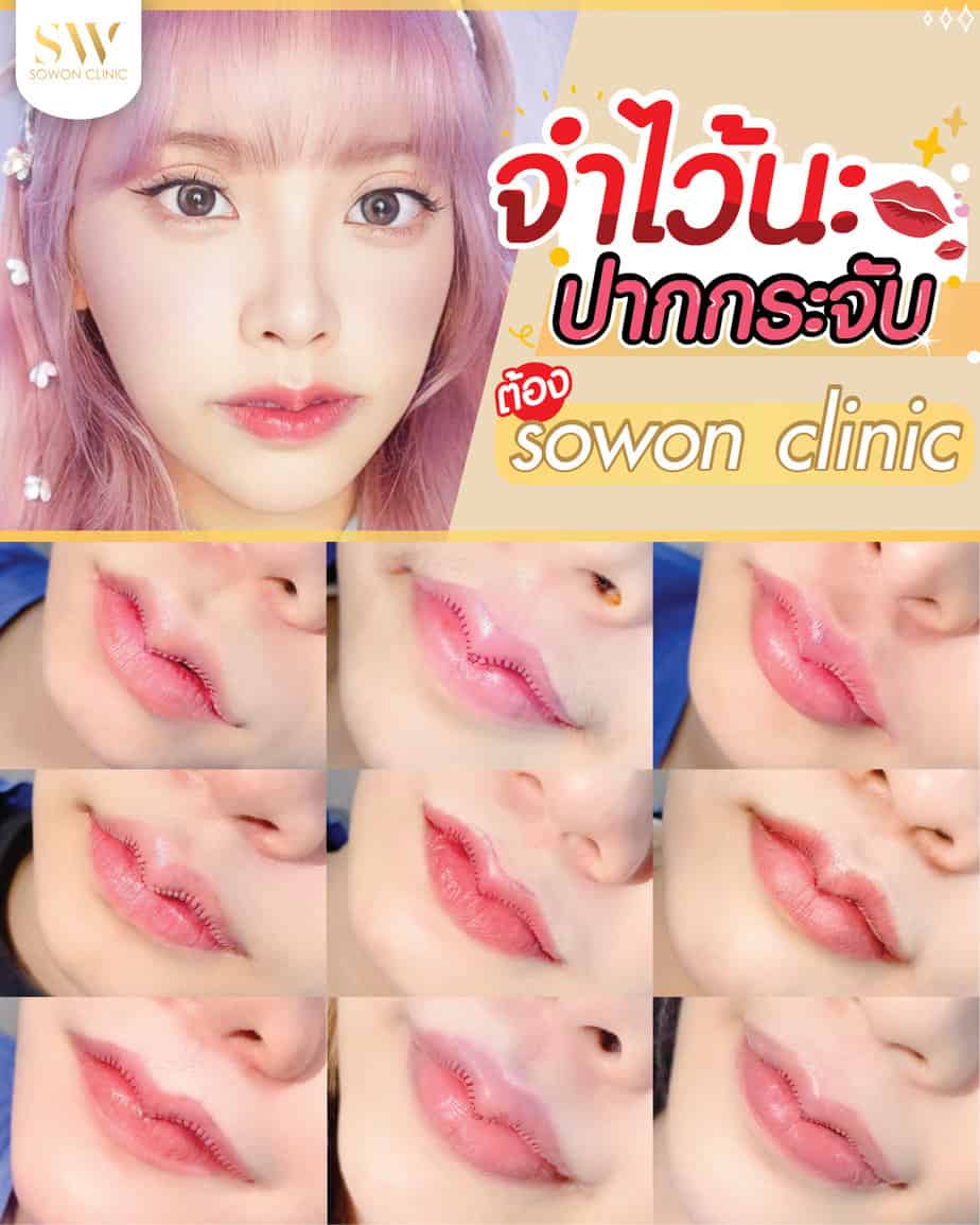 ปากใหญ่ ปากหนา ปากไม่สวย ยิ้มไม่มั่นใจ ทำปากกระจับยกมุมปากสวยสุดปัง  รับส่วนลดสูงสุด 9,000 - Sowon Clinic