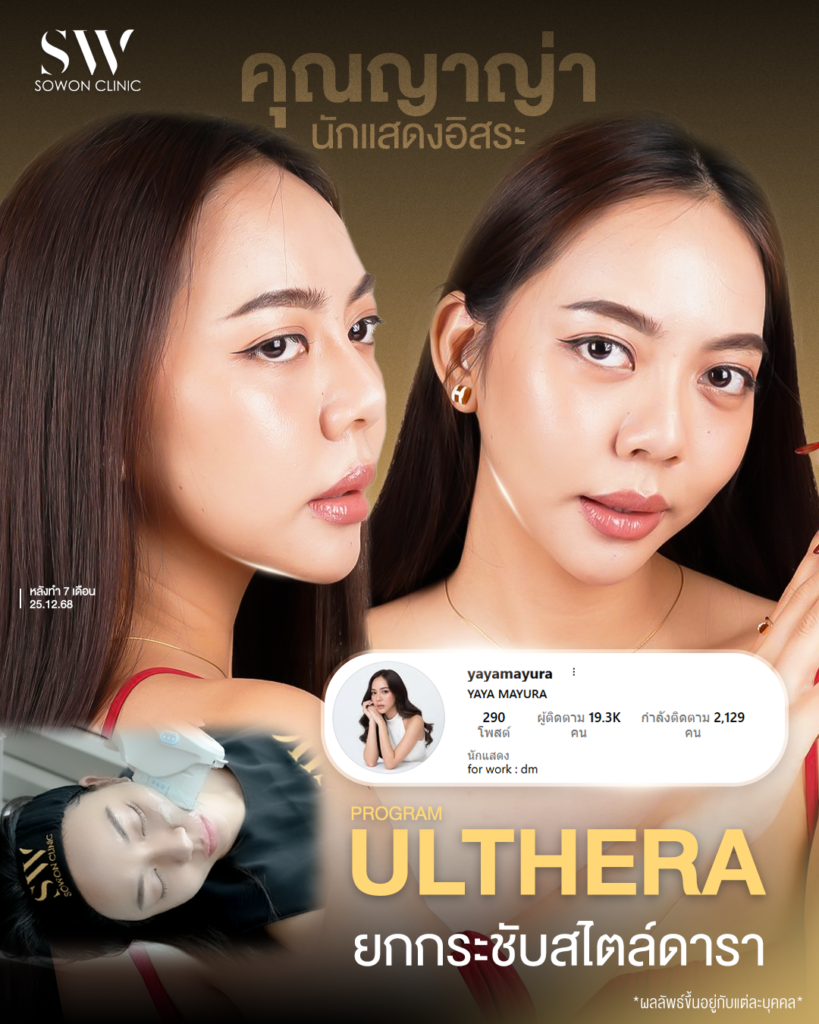 ulthera review