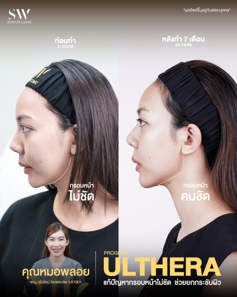 ulthera review