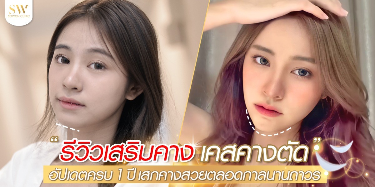 รีวิวเสริมคาง