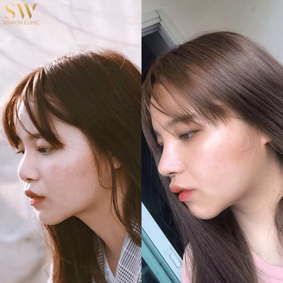 ทำจมูกเจ็บไหม