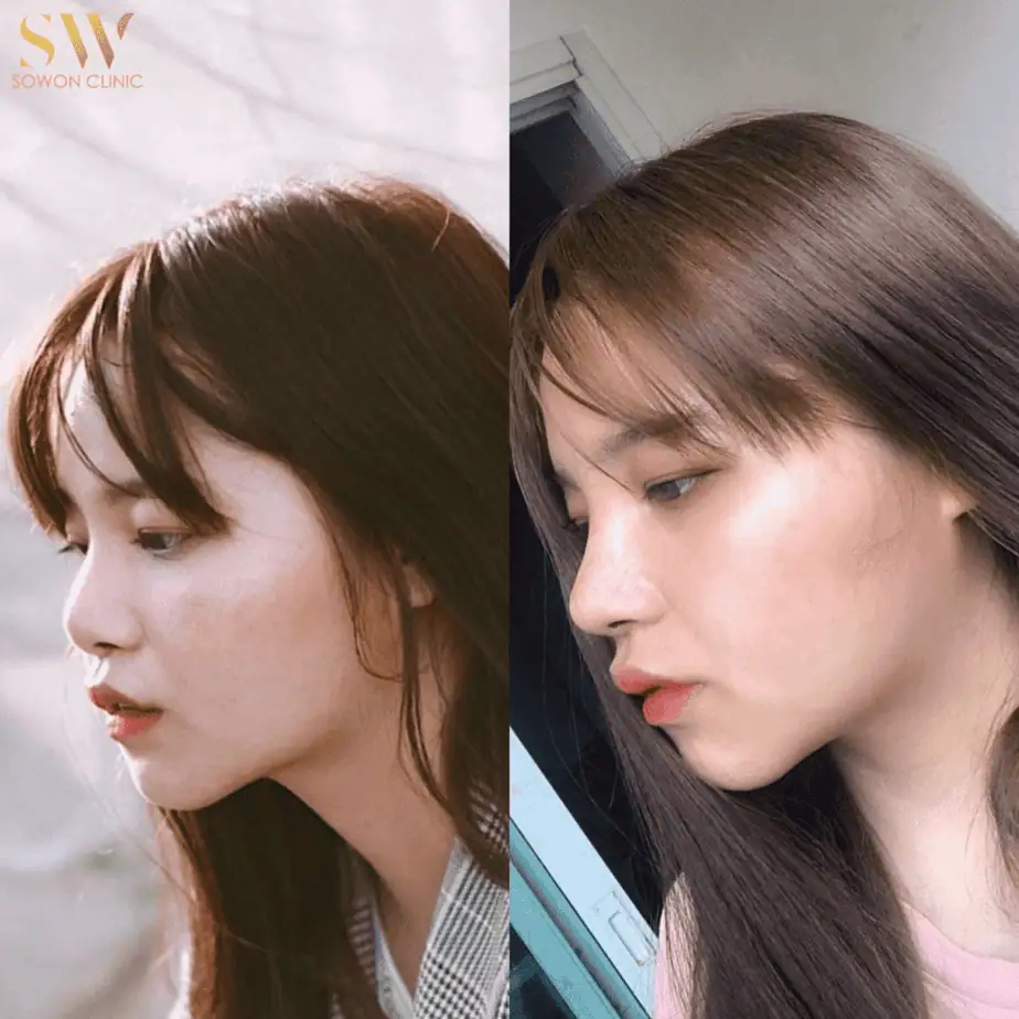 ทำจมูกเจ็บไหม