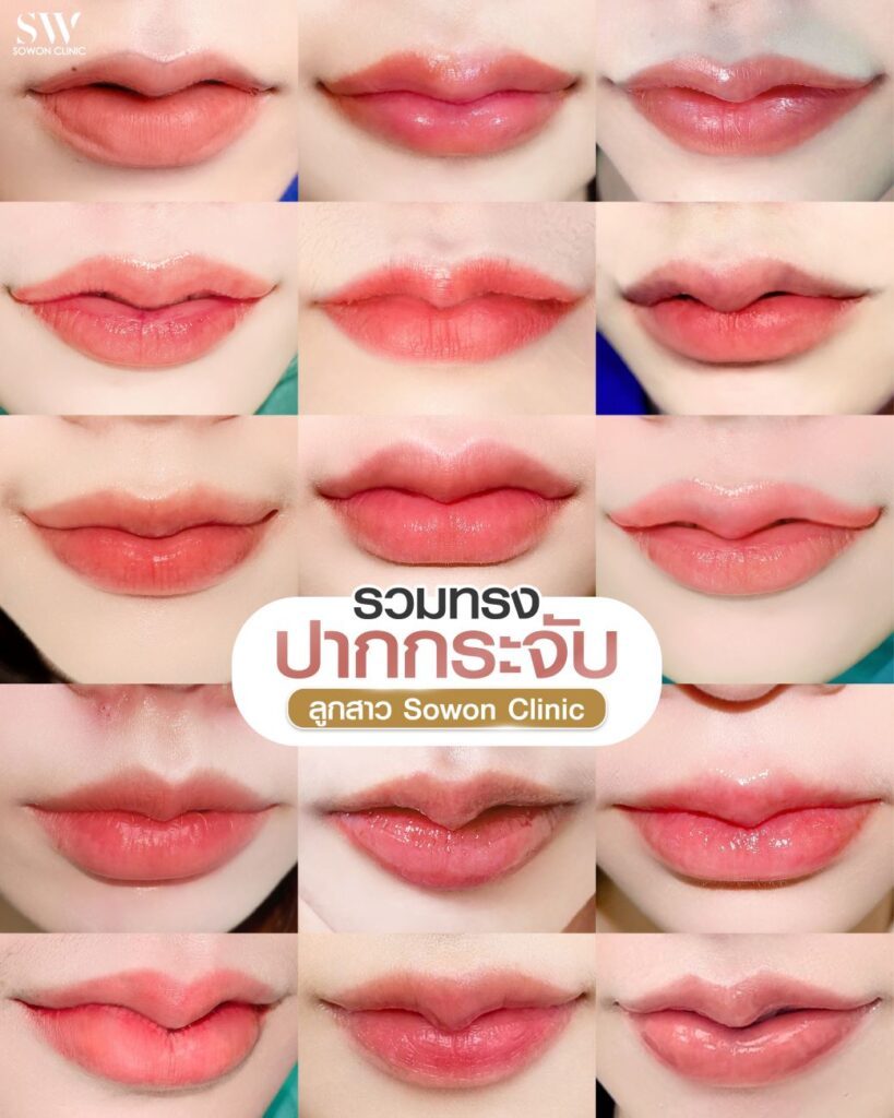 รีวิวโซวอน คลินิก รวมทรงปาก