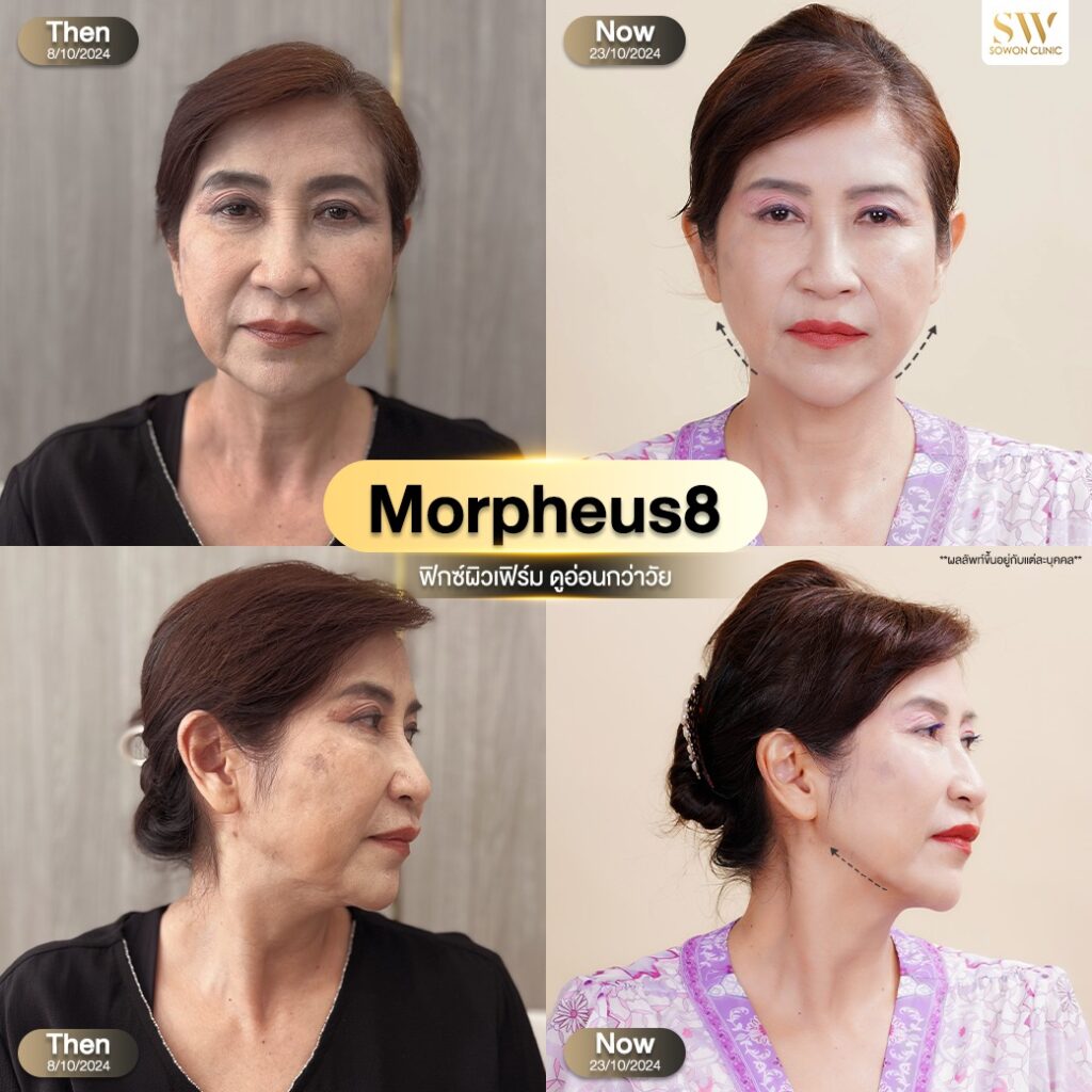 morpheus8 รีวิว02