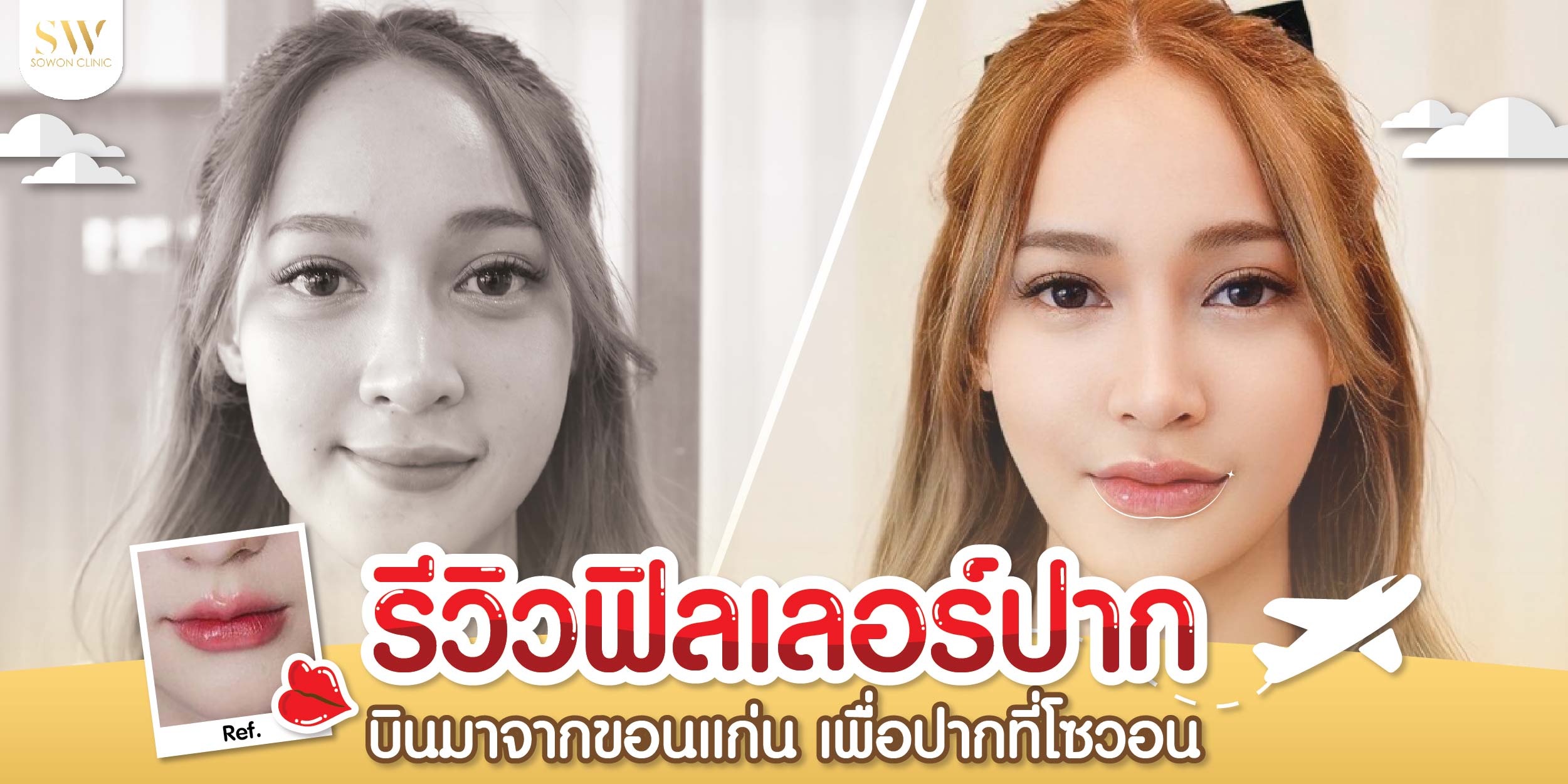 รีวิวฟิลเลอร์ปาก