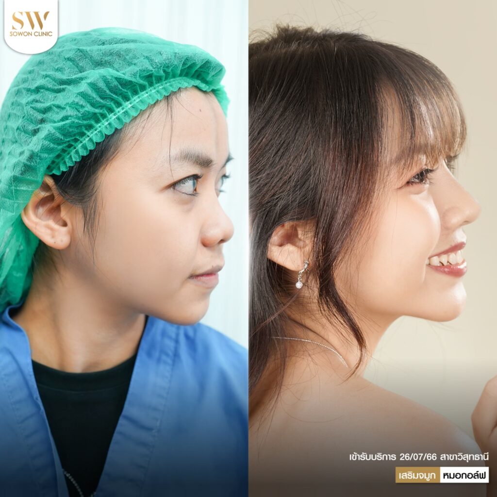 หมอกอล์ฟรีวิว06