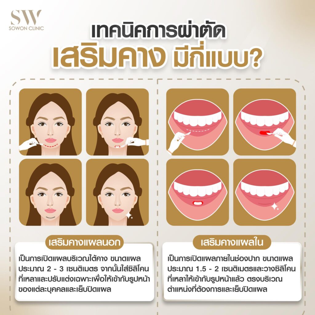 เสริมคางหมอแพน1