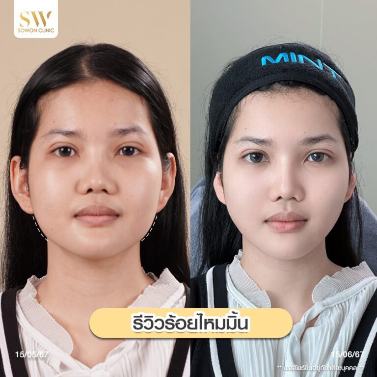 โปรโมชั่นร้อยไหม ร้อยไหมมิ้นท์ลูกสาว Sowon