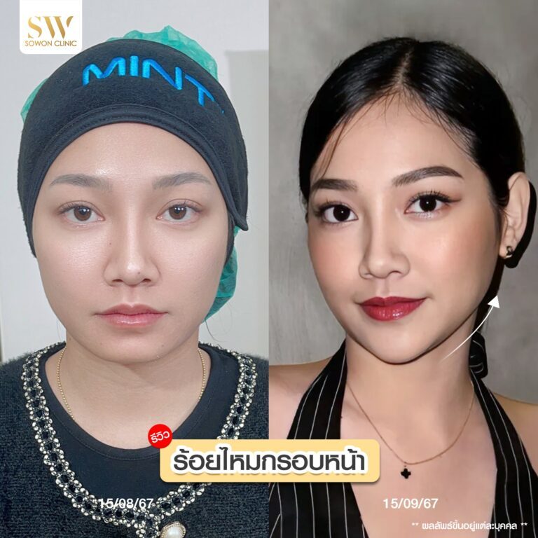 โปรโมชั่นร้อยไหม รีวิวร้อยไหม ลุกสาวโซวอน04