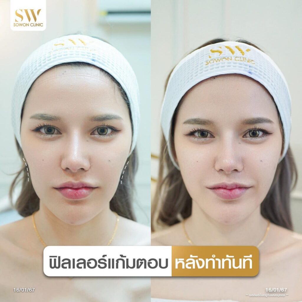 รีวิวฟิลเลอร์แก้มตอบ