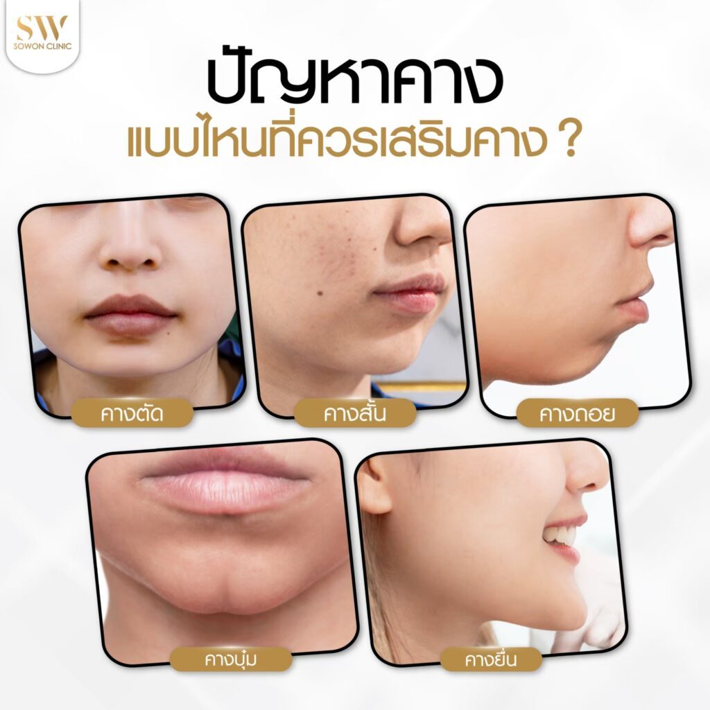 ปัญหาคางแบบไหนที่ควรเสริม