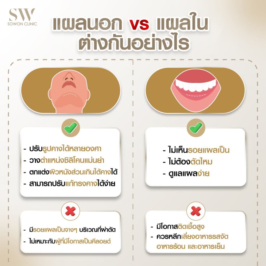 เสริมคางแผลนอก-แผลใน Sowon Clinic