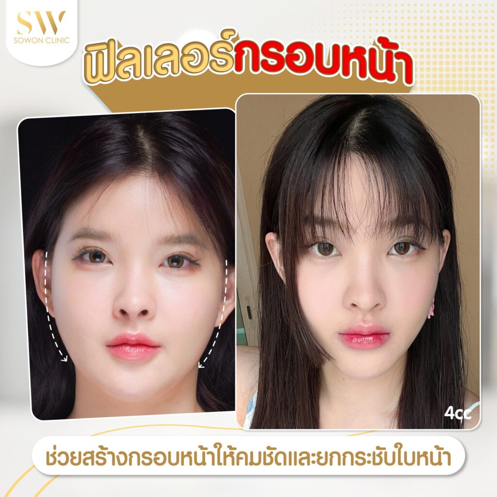 ฉีดฟิลเลอร์บริเวณกรอบหน้า-Sowon-Clinic